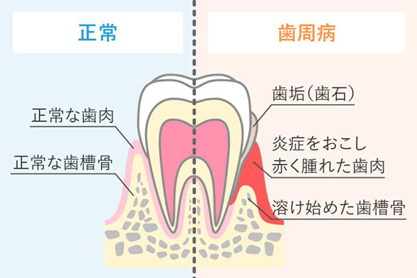 歯周病比較表